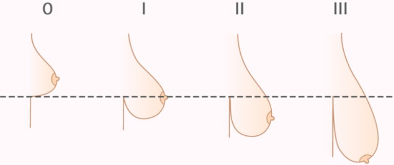 обвисла грудь: мастоптоз, опущение груди