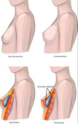 установка имплантатов груди 2 варианта