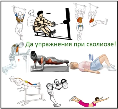 что можно из упражнений при сколиозе