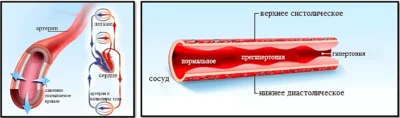 Гипертония наглядный процесс что такое давление крови пояснение