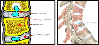 Грыжа Шморля что такое грыжа Шморля