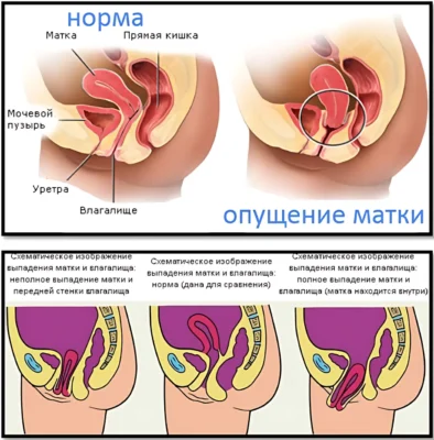 что такое опущение матки пояснение