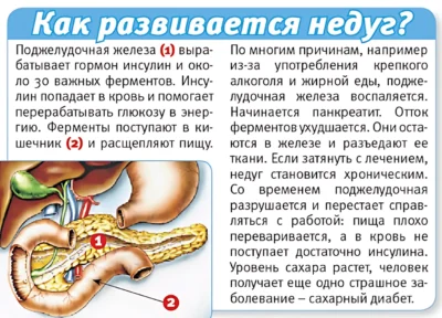 Как разивается панкреатит как развивается панкреатит