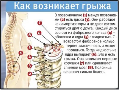 Как возникает грыжа как возникает грыжа памятка