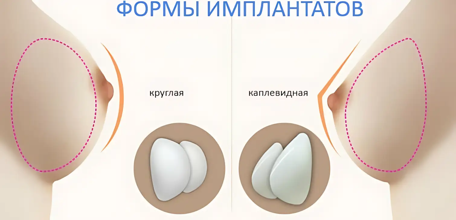 formyi-implantatov-grudi