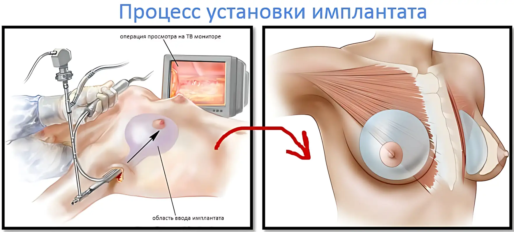 protsess-ustanovki-implantata-grudi