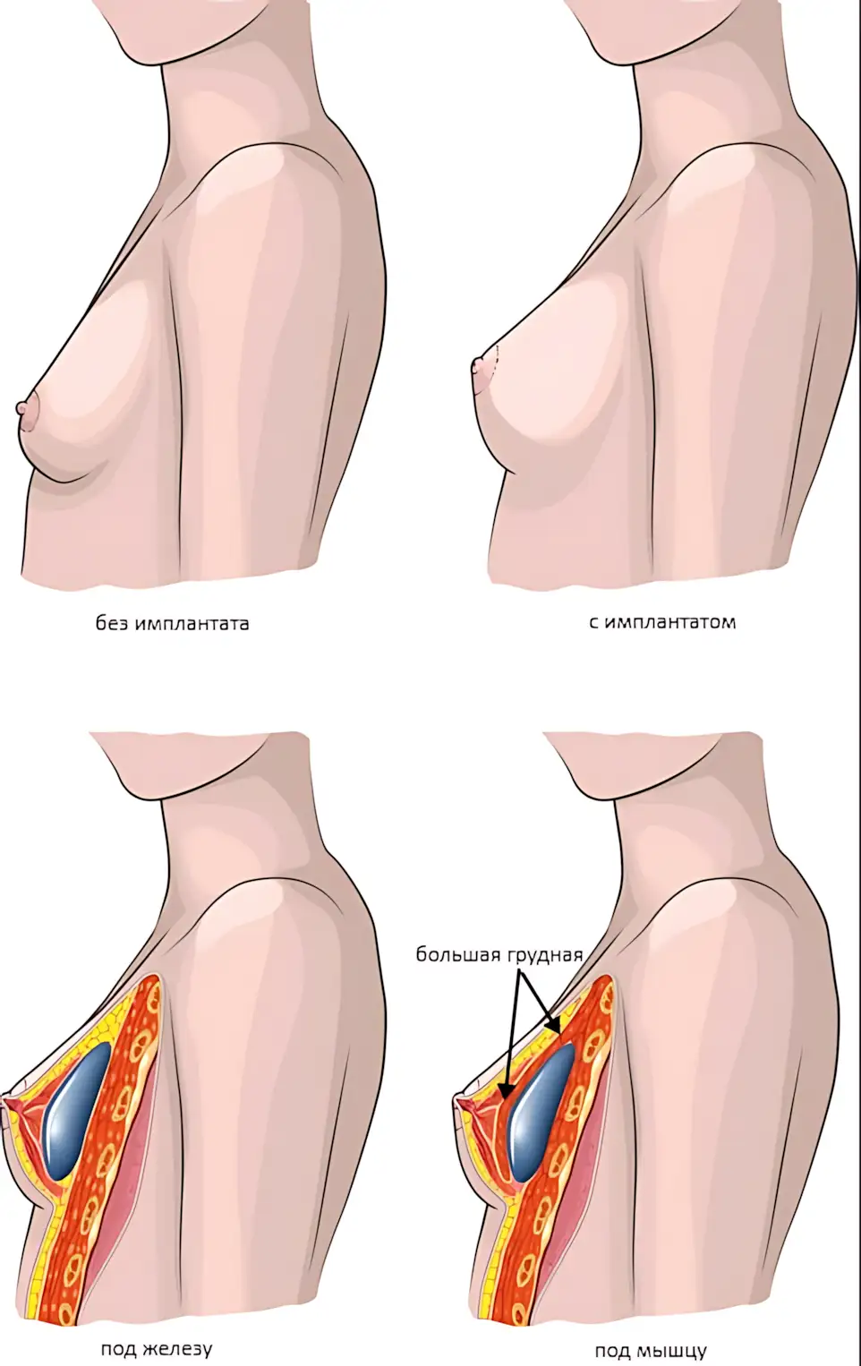 ustanovka-implantatov-grudi-2-varianta