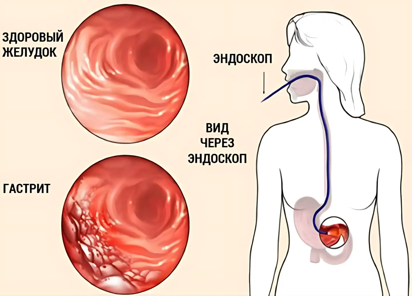 gastrit gastrit