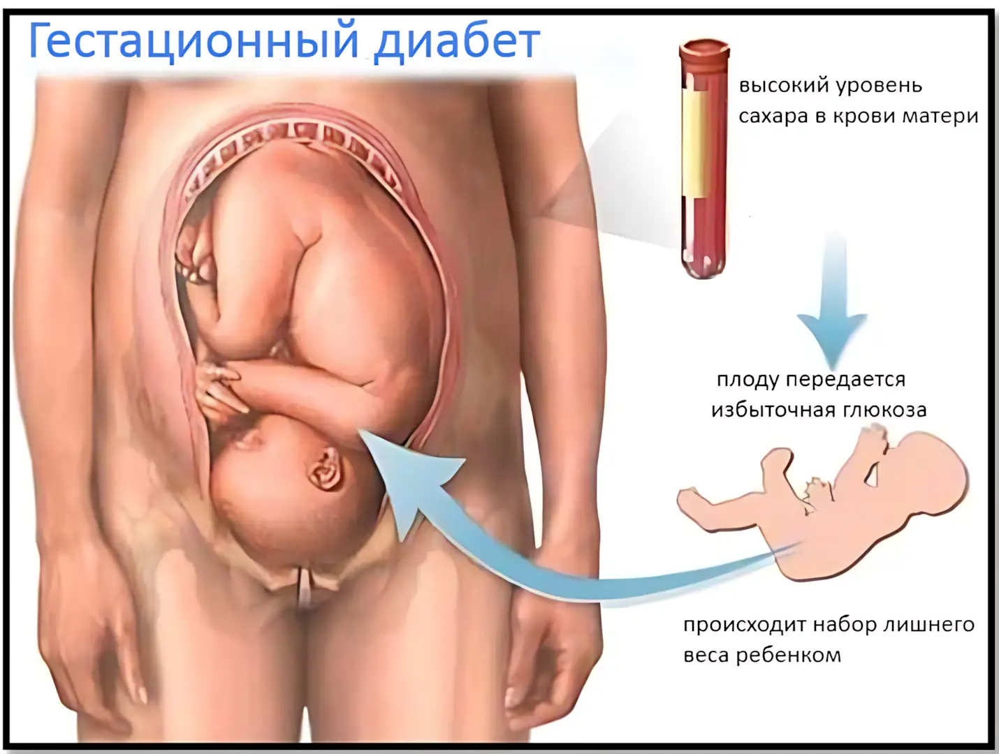 гестационный диабет у матери и ребенка гестационный диабет у матери и ребенка