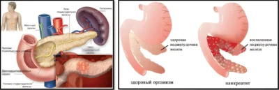 Поджелудочная железа и панкреатит chto-takoe-pankreatit-poyasnenie