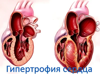 гипертрофия сердца gipertrofiya-serdcza