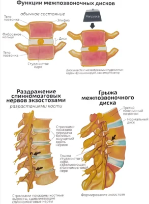 Последствия работы с весами: грыжа mezhpozvonochnye-diski-funkczii-i-gryzha-diska