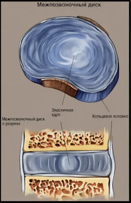 межпозвоночный диск mezhpozvonochnyj-disk