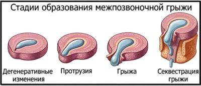 Стадии образования межпозвоночной грыжи stadii-gryzhi