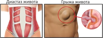 диастаз и грыжа живота от повышения внутрибрюшного давления